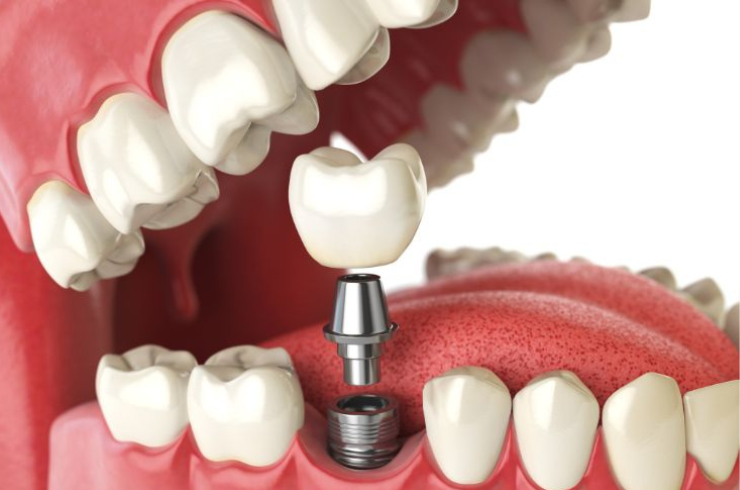 Dental Implants 